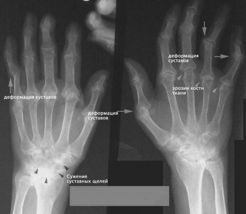 Болят суставы рук. Симптомы и лечение основных болезней суставов рук: список распространенных