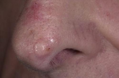 Базалиома носа лечение опыт. Базалиома кожи носа