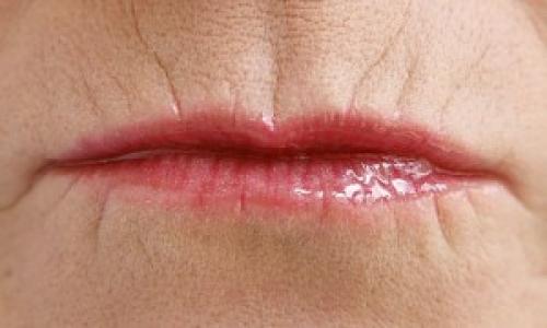 Как избавиться от кисетных морщин. Как и почему образуются кисетные морщины? 08