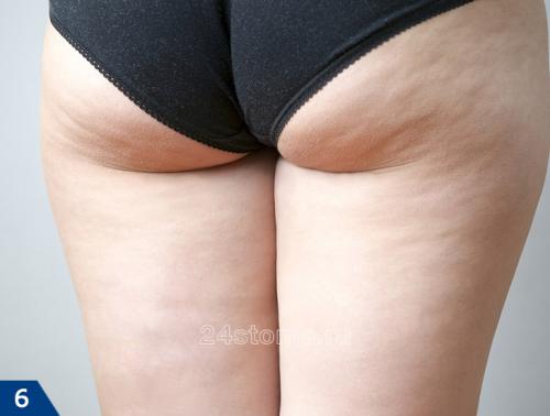 Lpg-массаж до и после. Оптимальные показания к LPG-массажу  –