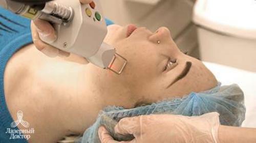 Избавиться от следов от прыщей в домашних условиях. Что можно сделать дома 08