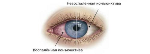 Почему верхнее веко покраснело и чешется: причины и способы лечения 01