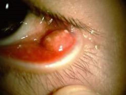 Заболевания кожи вокруг глаз и воспаление век: причины и лечение 05