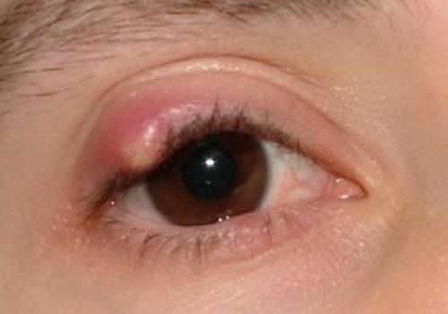 Заболевания кожи вокруг глаз и воспаление век: причины и лечение 04