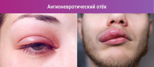Как отличить аллергический отек от других видов отеков. Симптомы отёка Квинке