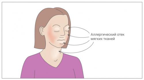 Как отличить аллергический отек от других видов отеков. Симптомы отёка Квинке