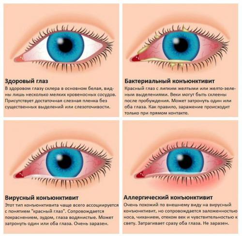 Если веки глаз чешутся. Почему чешутся глаза? 08 Если веки глаз чешутся. Почему чешутся глаза? 08