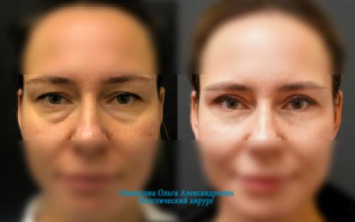 Японский массаж лица от отеков. Упражнения для устранения мешков под глазами