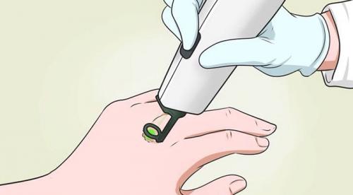 Лечение базалиомы перекисью водорода. Хирургическое лечение