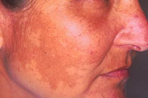 Как убрать возрастные пигментные пятна. Старческие пятна на лице: лечение 02