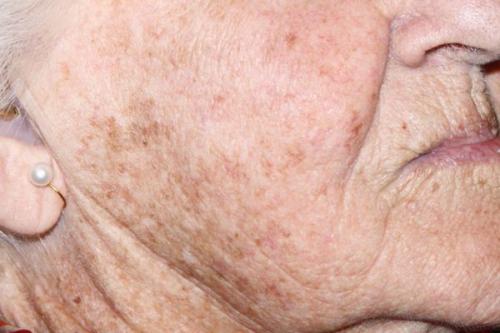 Как убрать возрастные пигментные пятна. Старческие пятна на лице: лечение 06