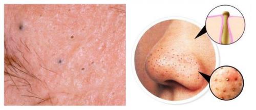 Чем убрать красные следы от прыщей. Мезотерапевтическое воздействие 03