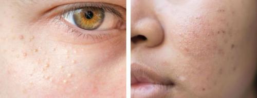 Чем убрать красные следы от прыщей. Мезотерапевтическое воздействие 02