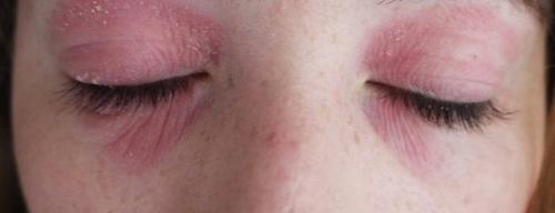 Диагностика шелушения на веке глаза. Симптомы 03 Диагностика шелушения на веке глаза. Симптомы 03