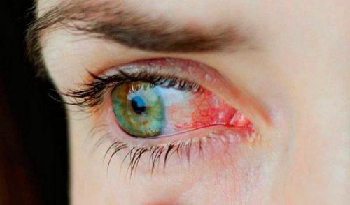 Глаза чешутся и краснеют. Симптомы заболевания 03 Глаза чешутся и краснеют. Симптомы заболевания 03