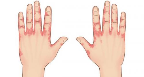 Атопический дерматит на веках и глазах. Симптомы аллергического конъюнктивита 01