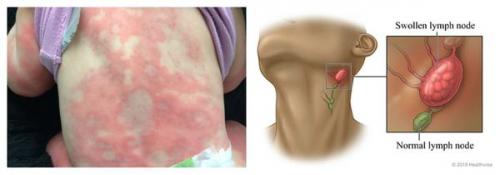 Таблетки от аллергии для взрослых. Антигистаминные препараты при аллергии: как сделать выбор? 03 Таблетки от аллергии для взрослых. Антигистаминные препараты при аллергии: как сделать выбор? 03