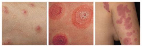 Таблетки от аллергии для взрослых. Антигистаминные препараты при аллергии: как сделать выбор? 01 Таблетки от аллергии для взрослых. Антигистаминные препараты при аллергии: как сделать выбор? 01