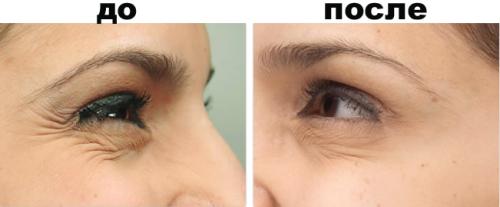 Как я избавилась от гусиных лапок. Как убрать гусиные лапки вокруг глаз