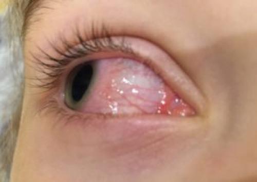 Чешутся глаза лечение. Почему чешутся глаза