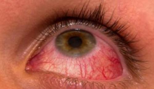 Чешутся глаза лечение. Почему чешутся глаза