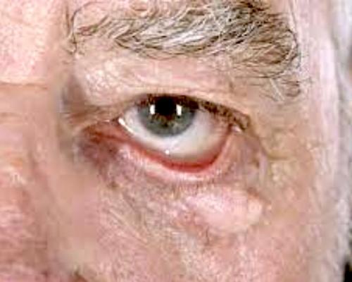 Причины зуда в глазах. Зуд в глазах: причины непатологического характера 03