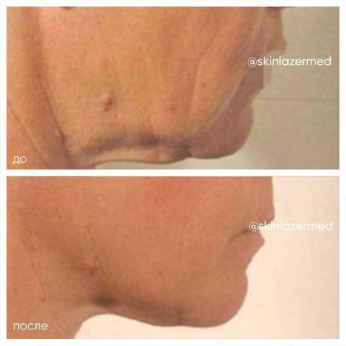 RF-лифтинг лица до и после. РФ лифтинг лица