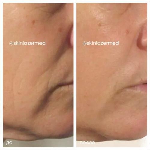 RF-лифтинг лица до и после. РФ лифтинг лица