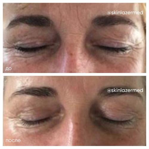 RF-лифтинг лица до и после. РФ лифтинг лица