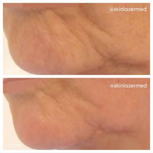 RF-лифтинг лица до и после. РФ лифтинг лица