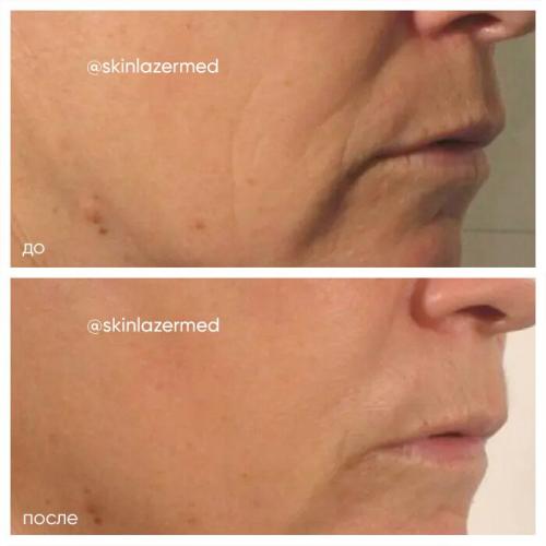 Рф лифтинг лица (до и после). РФ лифтинг лица