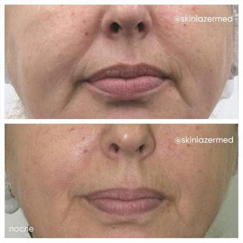 Рф лифтинг лица (до и после). РФ лифтинг лица