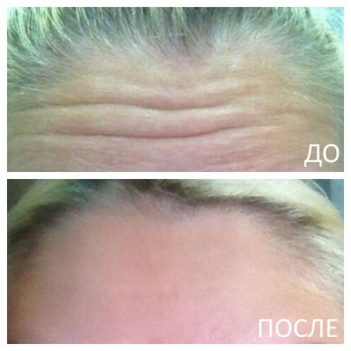 Сколько держится Ботокс на лбу в первый раз. Ботокс в лоб –, как это работает? 01