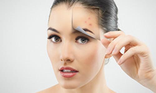 Самые лучшие средства от прыщей на лице. Чистая кожа раз и навсегда! Как победить акне?