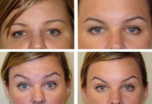 Через сколько встает ботокс после процедуры. Плюсы и минусы применения в косметологии 15 Через сколько встает ботокс после процедуры. Плюсы и минусы применения в косметологии 15