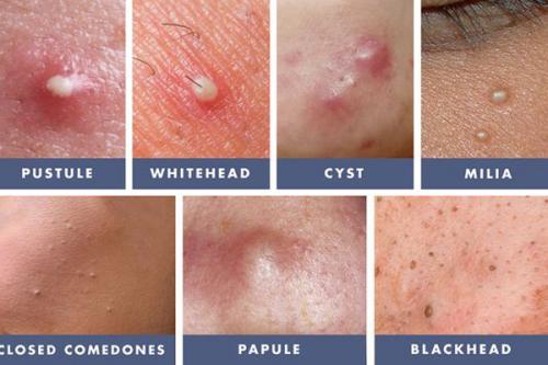 Как избавиться от красных следов после прыщей. Почему появляются следы от прыщей 06