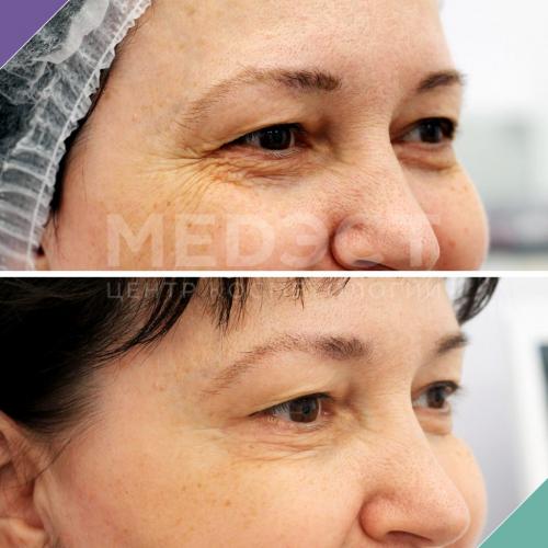 Как избавиться от морщин вокруг глаз в 40 лет женщине маски. Все способы избавиться от морщин вокруг глаз