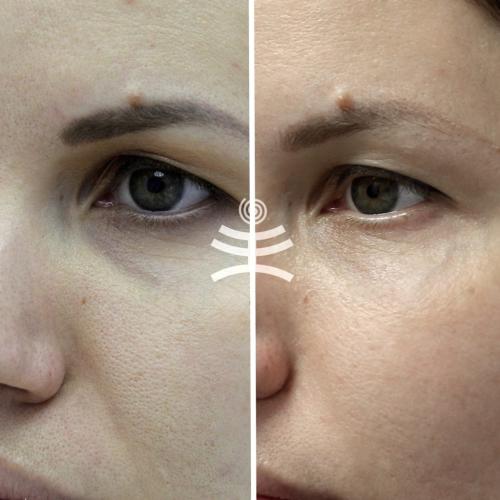 Как избавиться от морщин вокруг глаз в 40 лет женщине маски. Все способы избавиться от морщин вокруг глаз