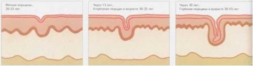 Методы коррекции мимических морщин. Классификация и типы морщин 01