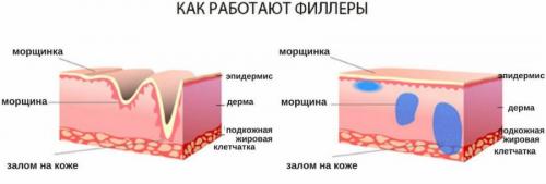 Сколько единиц ботокса надо на лицо в 40 лет. Часто задаваемые вопросы 02