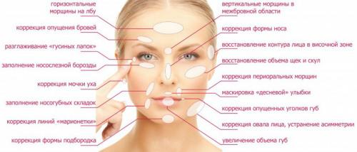 Сколько единиц ботокса надо на лицо в 40 лет. Часто задаваемые вопросы 03