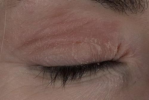 Чешется верхнее веко и шелушится. Особенности кожи век