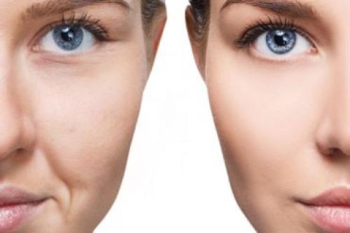 Безболезненное решение для морщин вокруг глаз: инъекции 02