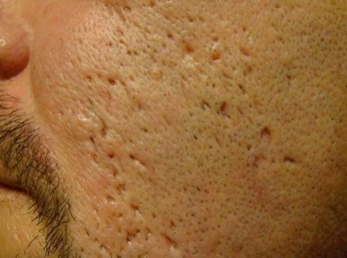 Безшовный метод: как избавиться от шрамов прыщей 02