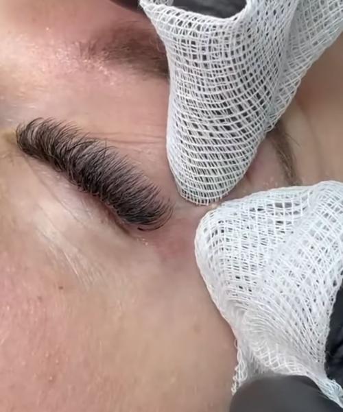 Как избежать появления новых комедонов после удаления. Лечение милиумов