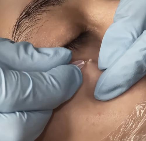 Как избежать появления новых комедонов после удаления. Лечение милиумов