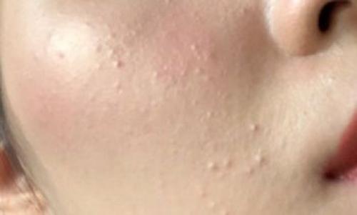 Противодействие комедонам: простые советы для здоровой кожи 03 Противодействие комедонам: простые советы для здоровой кожи 03