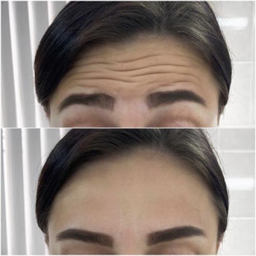 Омолаживание лица с помощью инъекций диспорта в лоб и межбровье 01 Омолаживание лица с помощью инъекций диспорта в лоб и межбровье 01