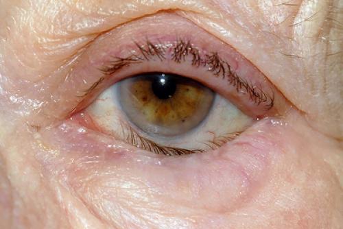 Почему глаза могут слезыться: основные причины и способы устранения 03