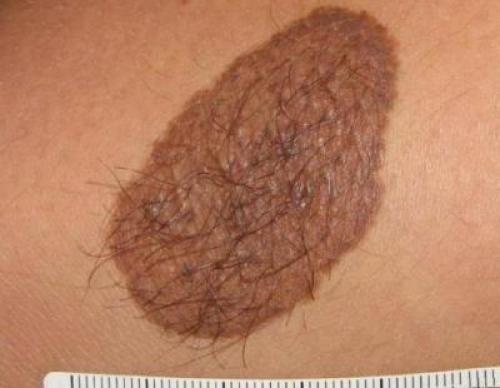 Победите пигментацию после прыщей: проверенные методы и рекомендации 01 Победите пигментацию после прыщей: проверенные методы и рекомендации 01